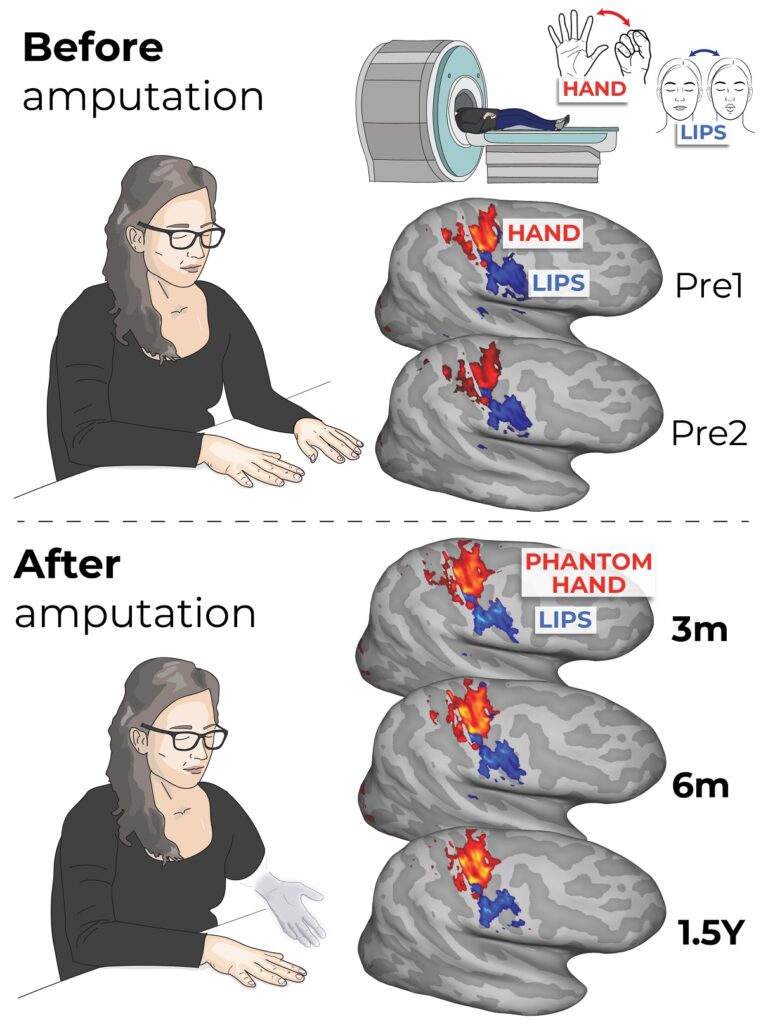 El cerebro conserva el mapa de miembros amputados, según un estudio pionero del NIH
