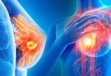 Tratamientos del cáncer del seno deben tomar en cuenta enfermedad del corazón