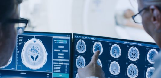 Ensayo clínico demuestra resultados positivos para mujeres con tumor cerebral