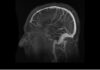 Nueva prueba no invasiva revoluciona diagnóstico del Alzheimer con precisión sin precedentes