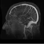 Nueva prueba no invasiva revoluciona diagnóstico del Alzheimer con precisión sin precedentes