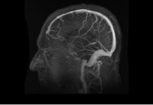 Nueva prueba no invasiva revoluciona diagnóstico del Alzheimer con precisión sin precedentes