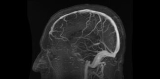 Nueva prueba no invasiva revoluciona diagnóstico del Alzheimer con precisión sin precedentes