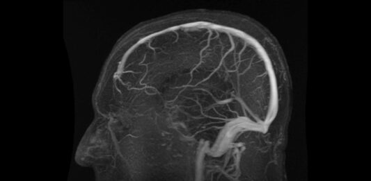 Nueva prueba no invasiva revoluciona diagnóstico del Alzheimer con precisión sin precedentes