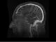 Nueva prueba no invasiva revoluciona diagnóstico del Alzheimer con precisión sin precedentes