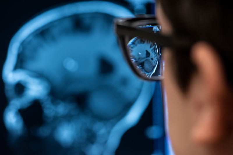 Los cambios en la forma del cerebro predicen el deterioro cognitivo, según un nuevo estudio