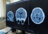 La FDA autoriza fármaco contra una rara enfermedad neurológica Zanvastro actúa sobre la proteína que impulsa este trastorno neurológico raro y fue autorizado para pacientes pediátricos y adultos.