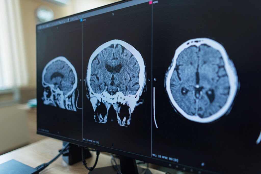 Zanvastro actúa sobre la proteína que impulsa este trastorno neurológico raro y fue autorizado para pacientes pediátricos y adultos.