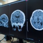 Zanvastro actúa sobre la proteína que impulsa este trastorno neurológico raro y fue autorizado para pacientes pediátricos y adultos.