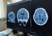 La FDA autoriza fármaco contra una rara enfermedad neurológica Zanvastro actúa sobre la proteína que impulsa este trastorno neurológico raro y fue autorizado para pacientes pediátricos y adultos.