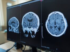 La FDA autoriza fármaco contra una rara enfermedad neurológica Zanvastro actúa sobre la proteína que impulsa este trastorno neurológico raro y fue autorizado para pacientes pediátricos y adultos.
