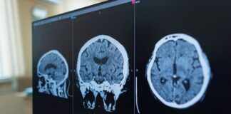 La FDA autoriza fármaco contra una rara enfermedad neurológica Zanvastro actúa sobre la proteína que impulsa este trastorno neurológico raro y fue autorizado para pacientes pediátricos y adultos.