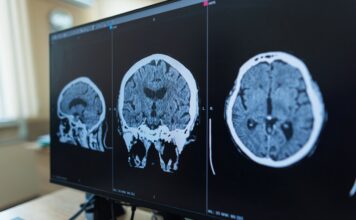 La FDA autoriza fármaco contra una rara enfermedad neurológica Zanvastro actúa sobre la proteína que impulsa este trastorno neurológico raro y fue autorizado para pacientes pediátricos y adultos.