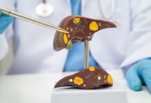La FDA aprueba Hibsago para ciertos adultos con hepatitis B crónica La FDA aprueba Hibsago para ciertos adultos con hepatitis B crónica